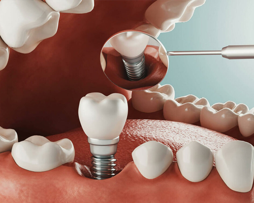 Dental Implants