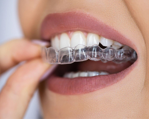 Invisalign