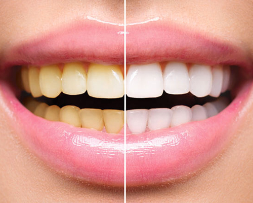 Scaling AND Polishing